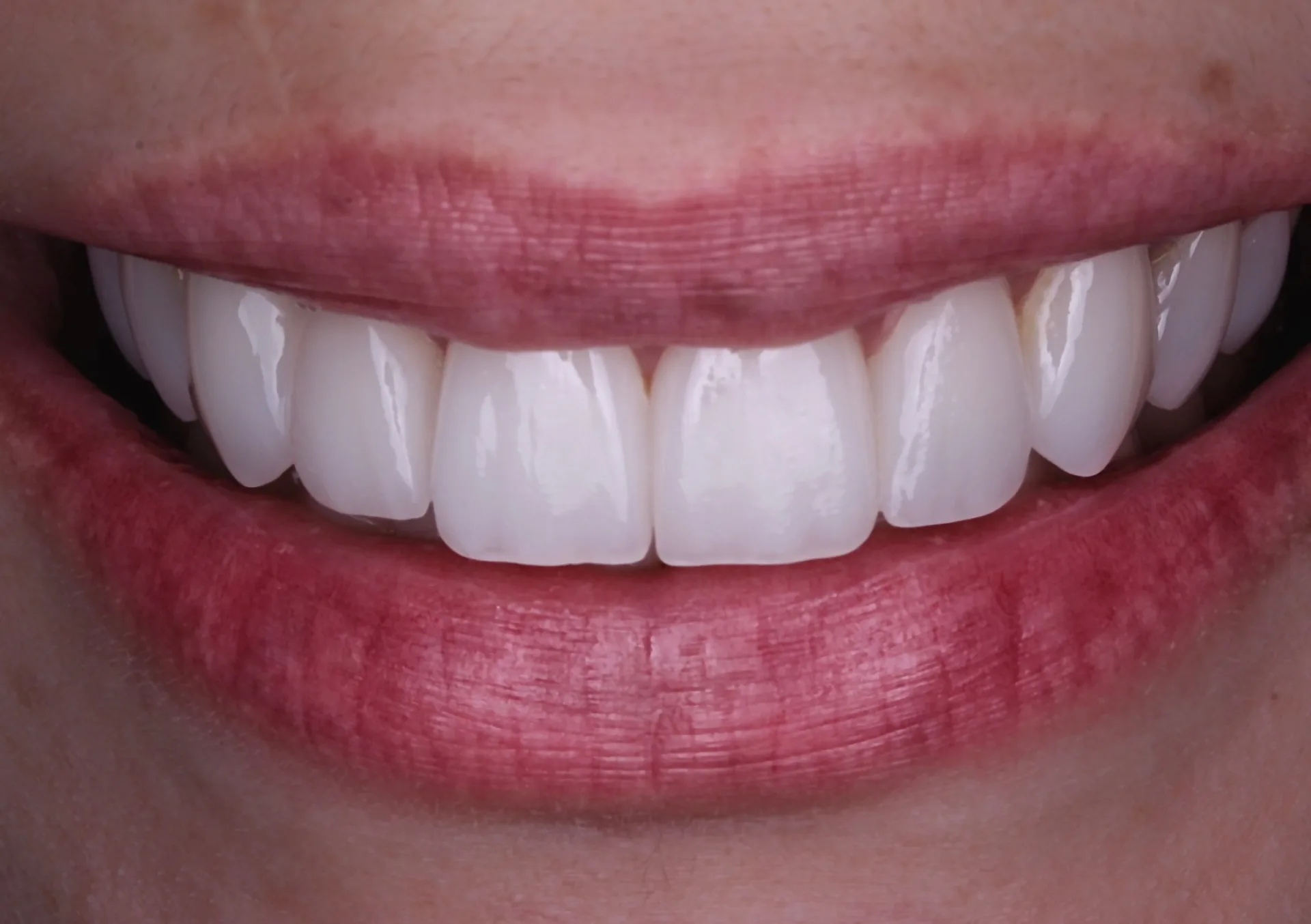 Carillas de porcelana — resultado natural