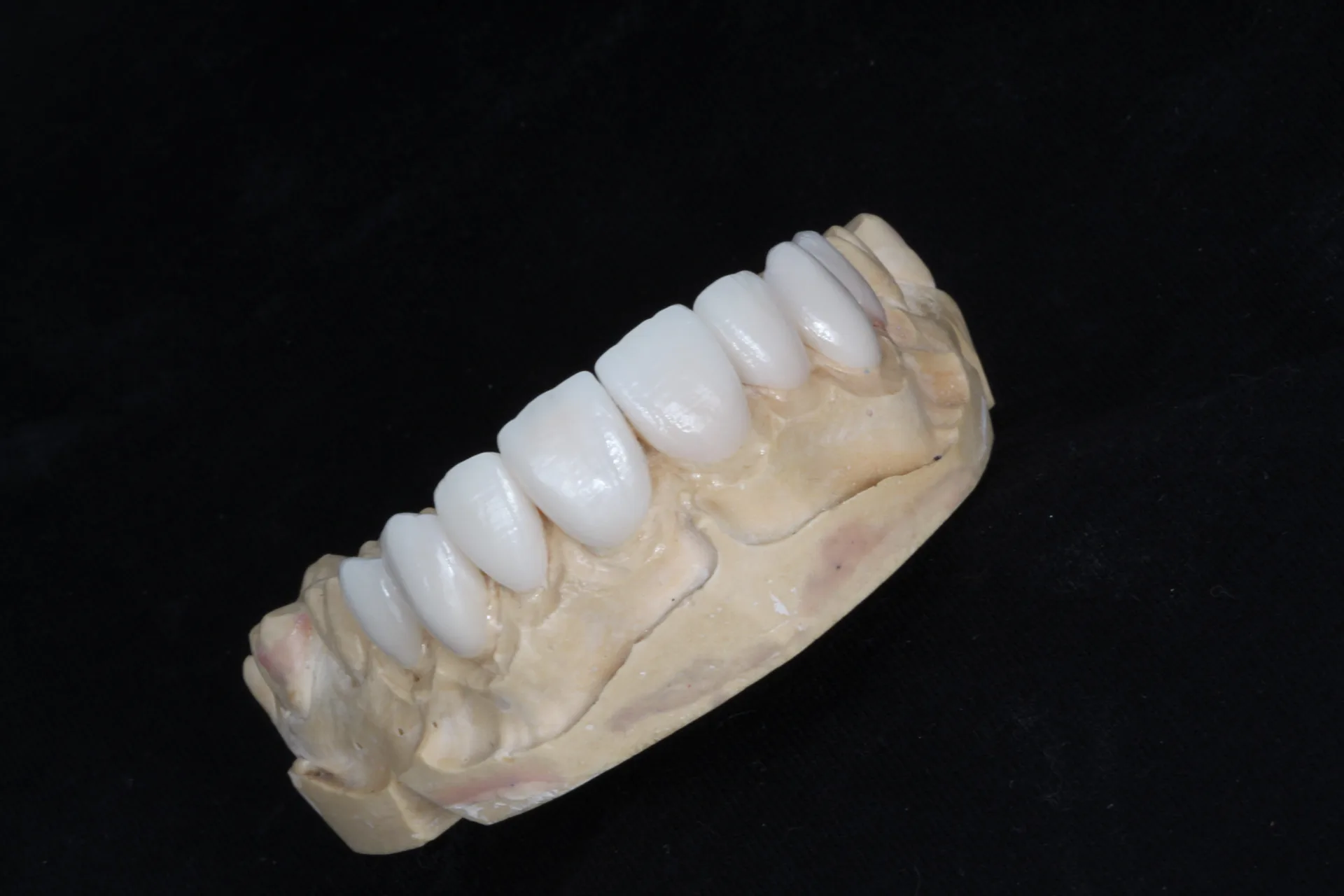 Detalle estético de carillas dentales