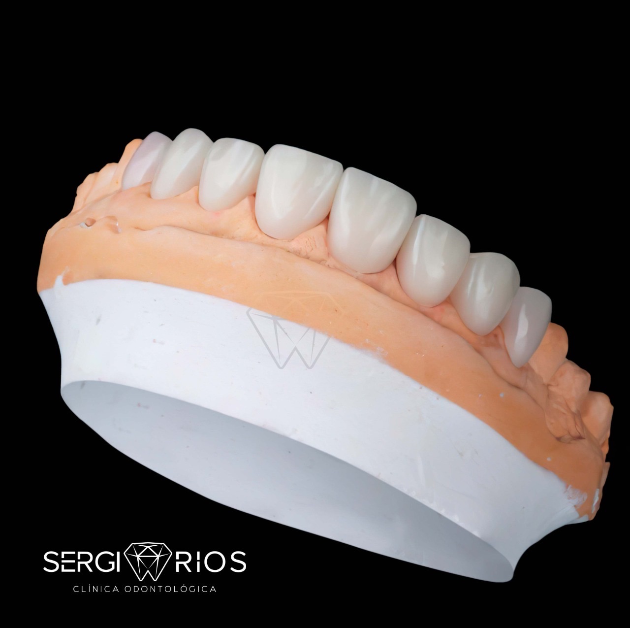 Restauración estética con coronas