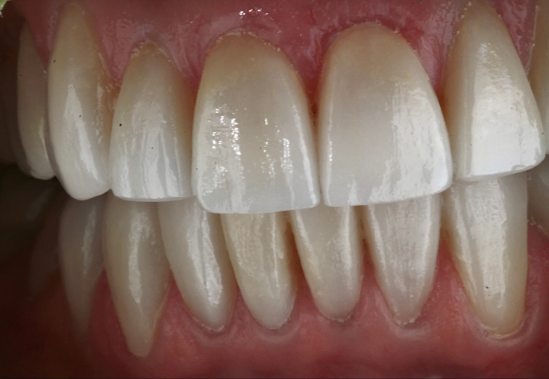 Coronas de porcelana — vista lateral