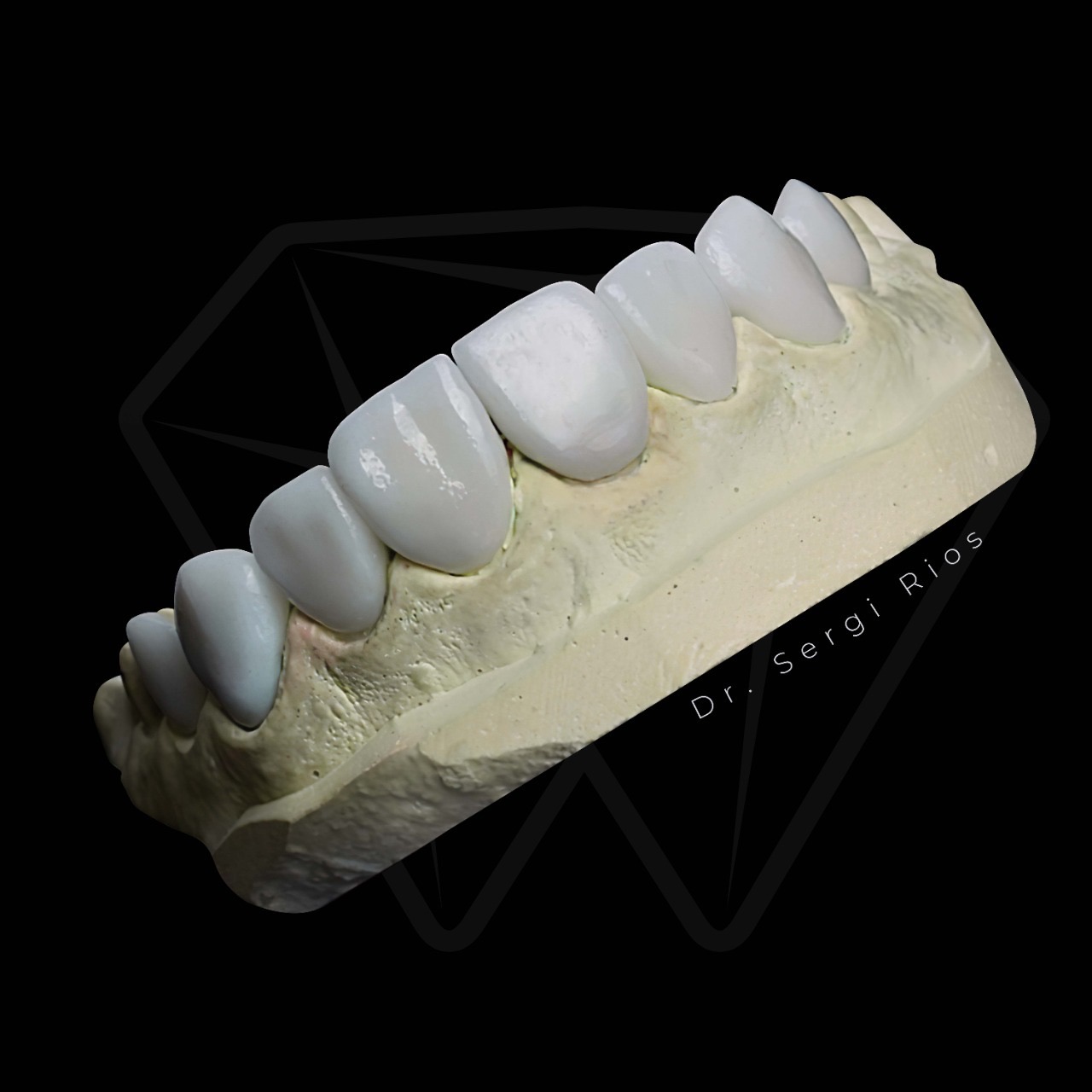 Detalle de coronas dentales
