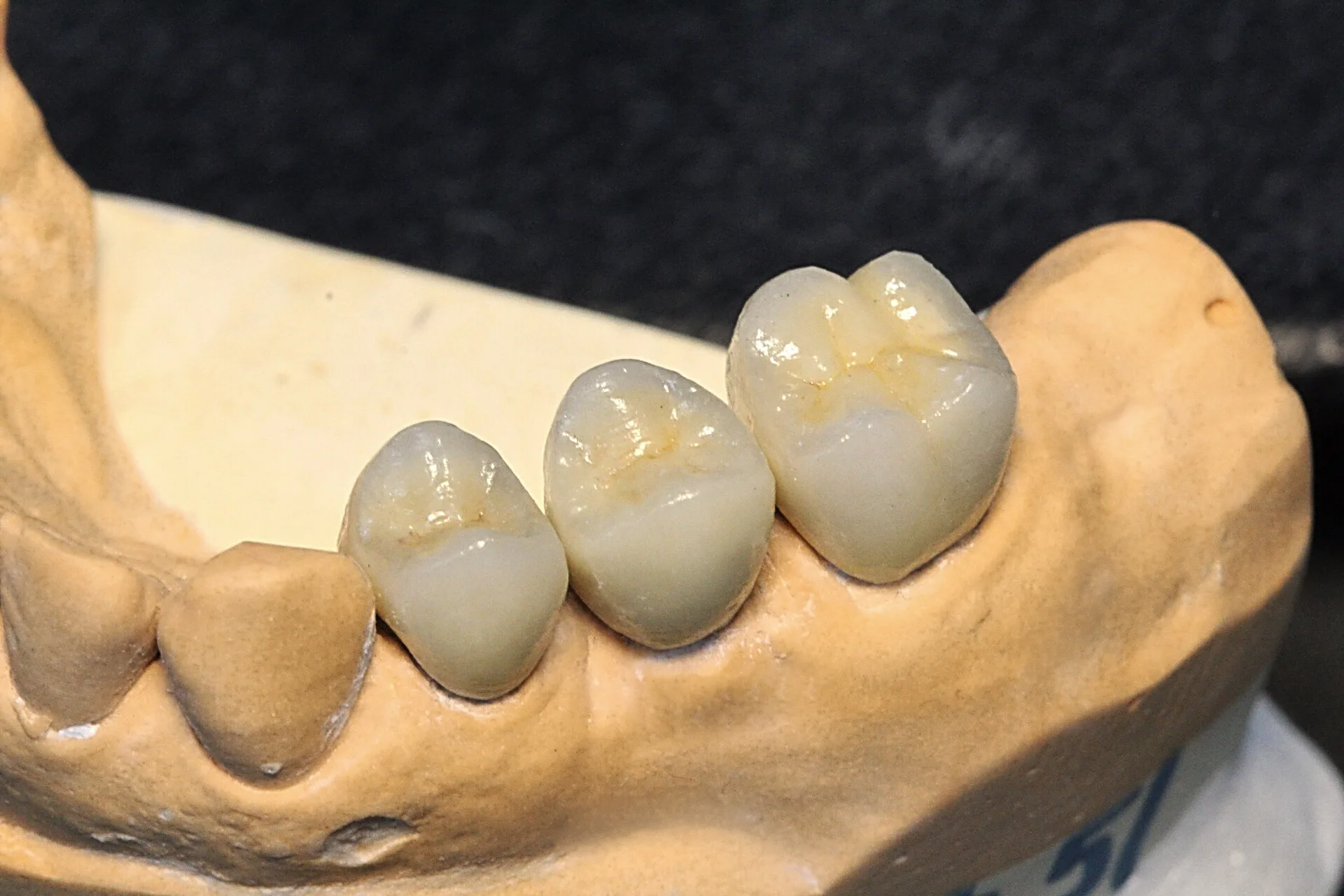 Coronas dentales — detalle clínico