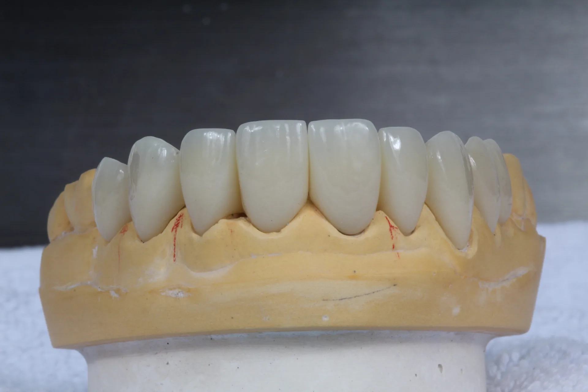 Coronas sobre zirconio — resultado estético