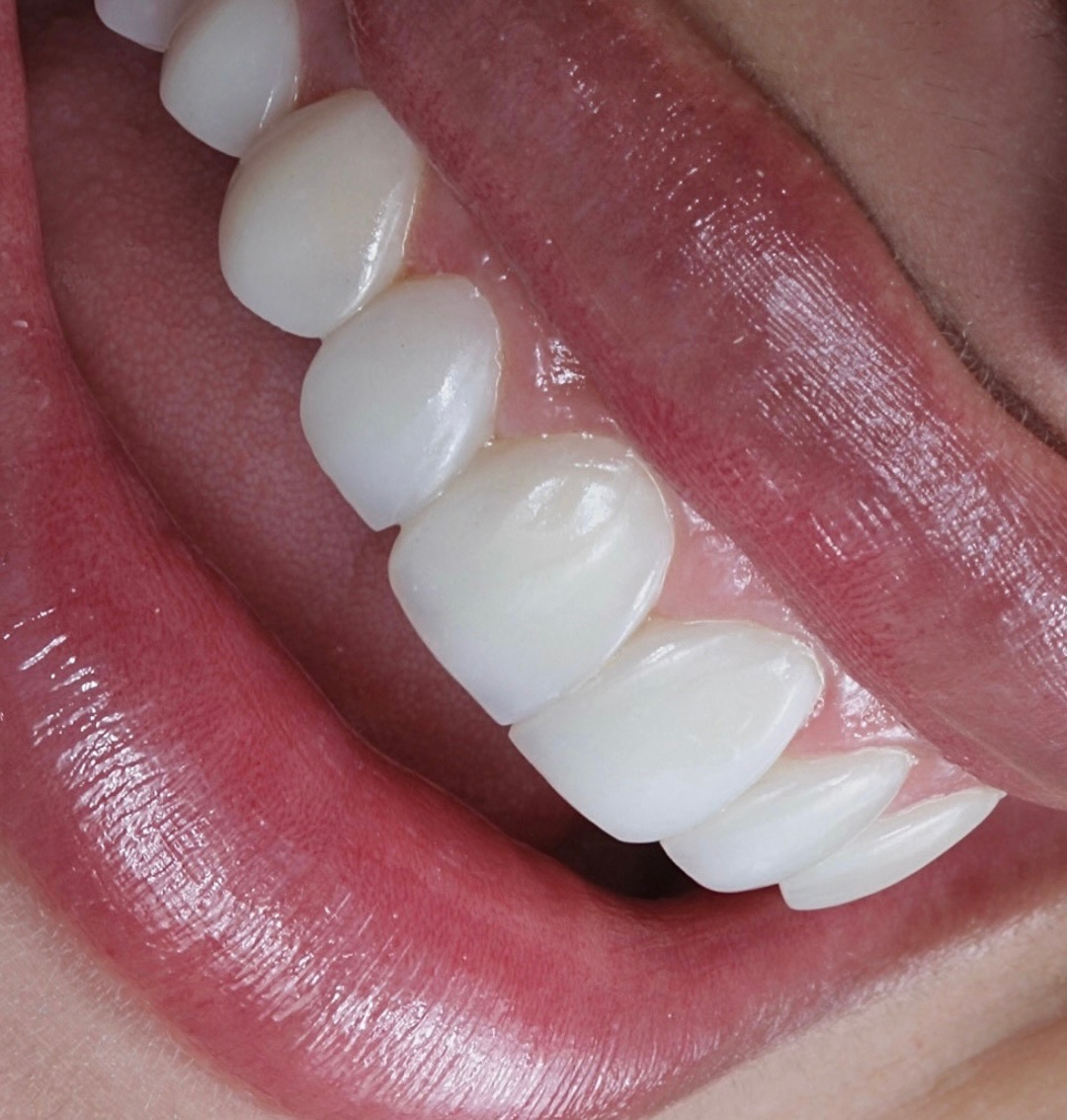 Caso clínico de diseño de sonrisa — Dr. Sergio Ríos