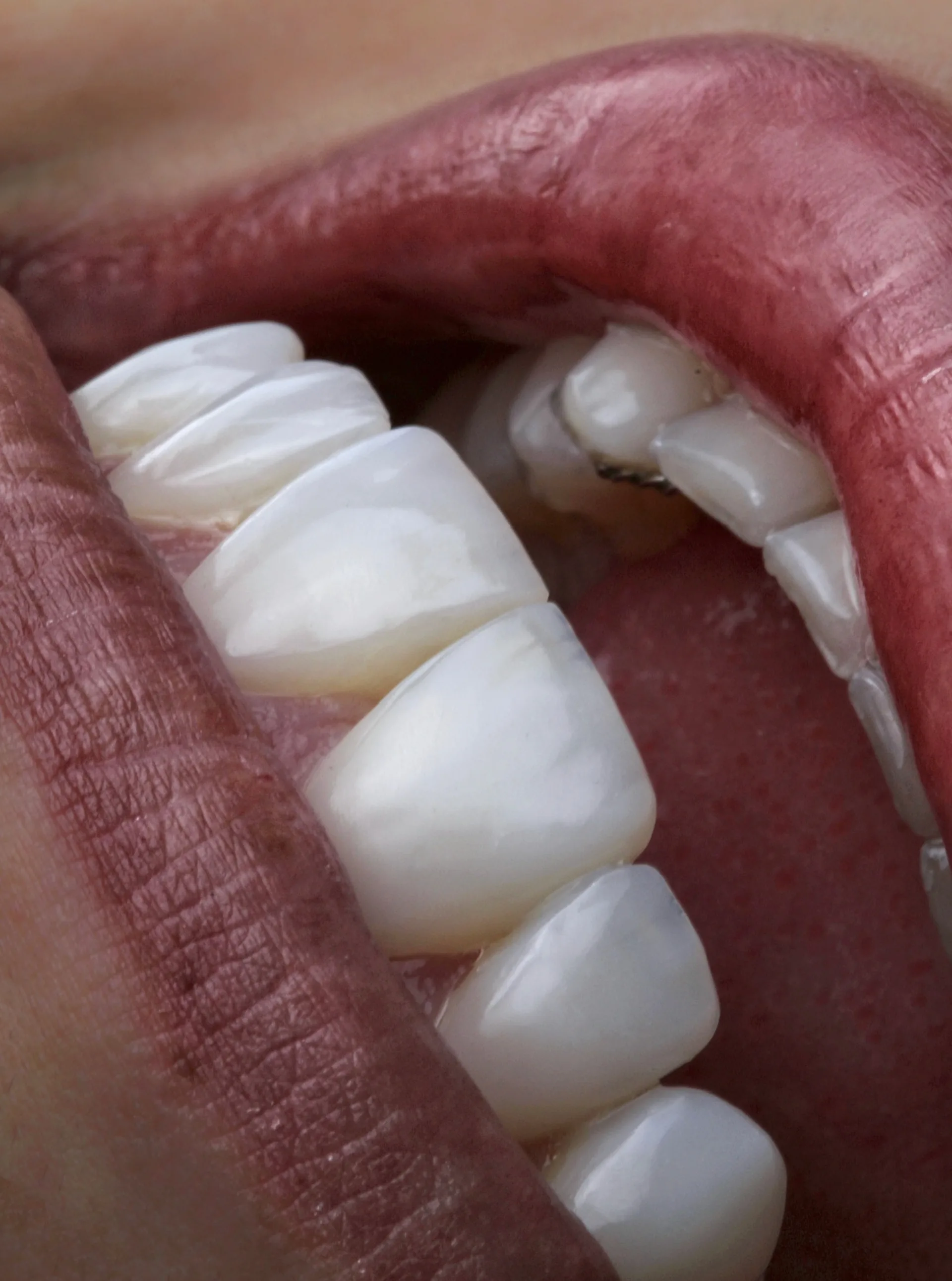 Diseño de sonrisa — alta estética dental