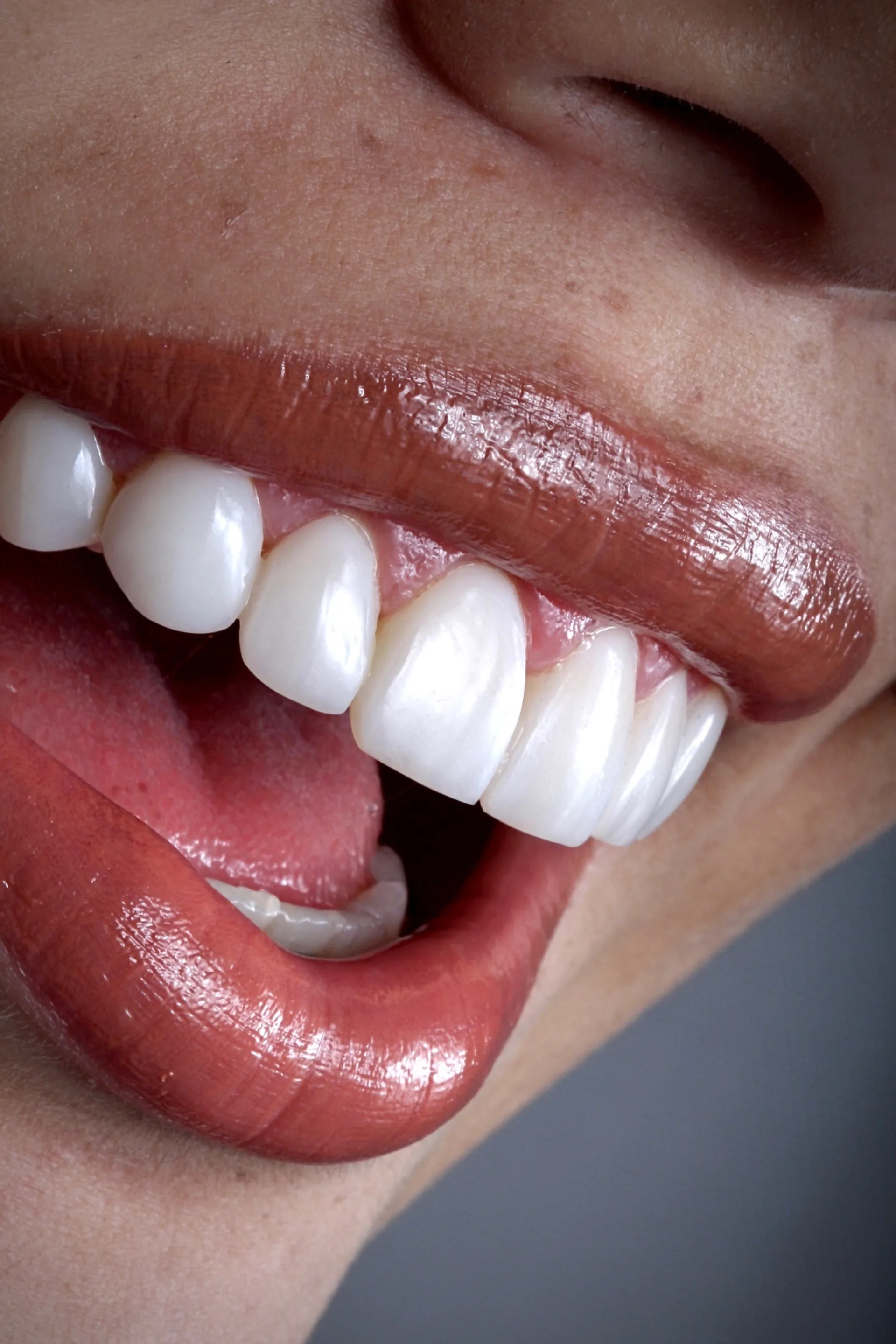 Diseño de sonrisa — caso documentado