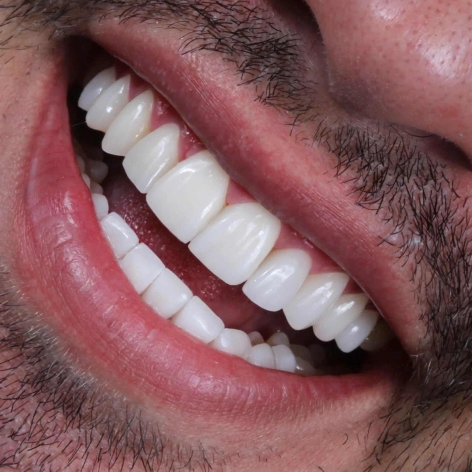 Diseño de sonrisa y alta estética dental