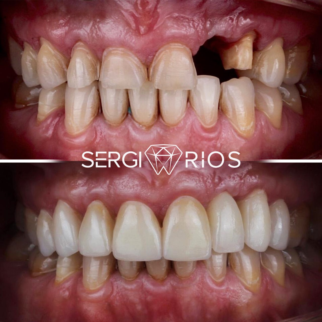 Rehabilitación con implantes dentales — Medellín