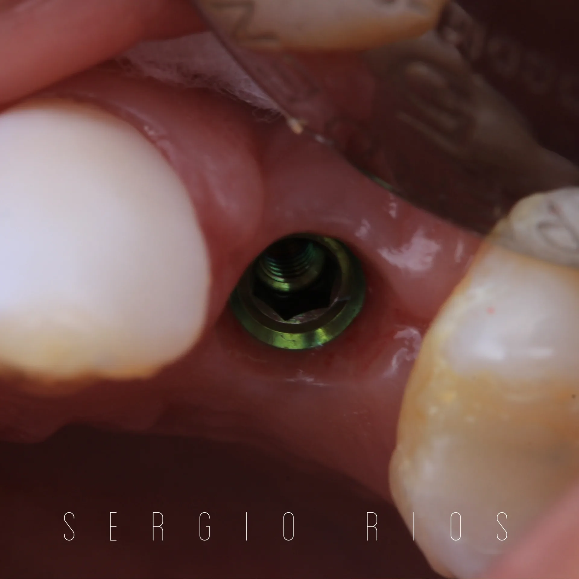 Implante dental con carga inmediata — Medellín