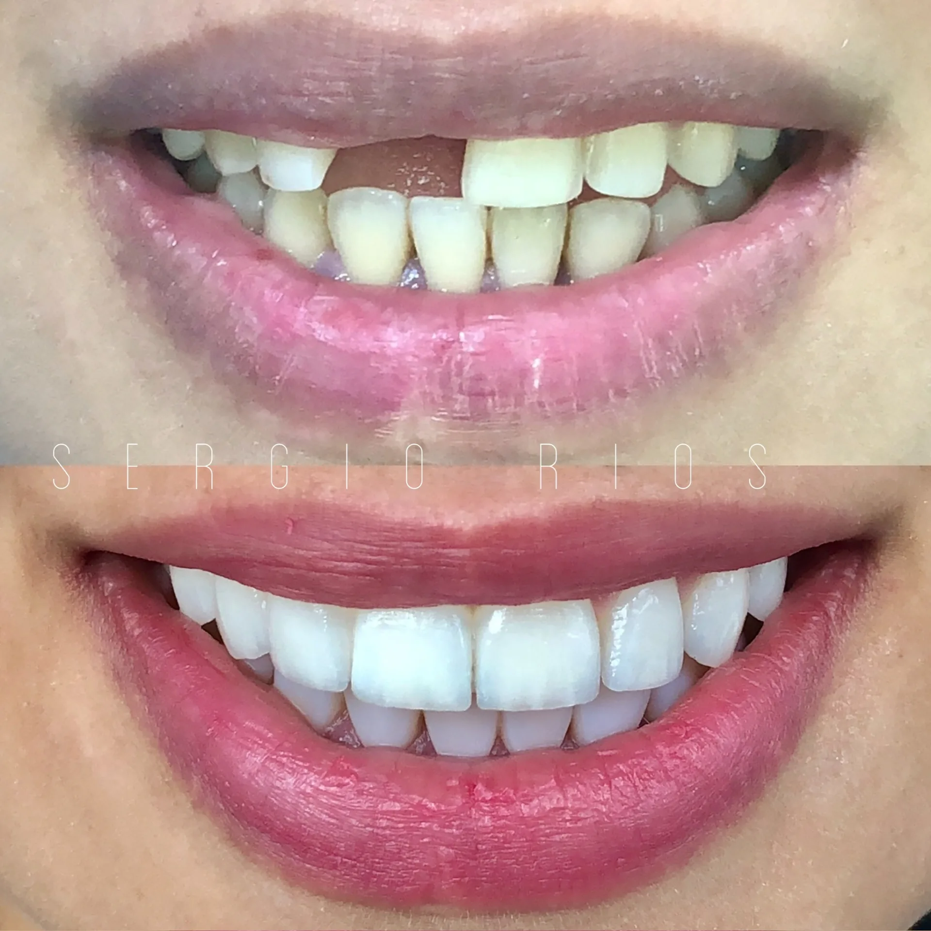 Cirugía guiada 3D con implantes — Medellín