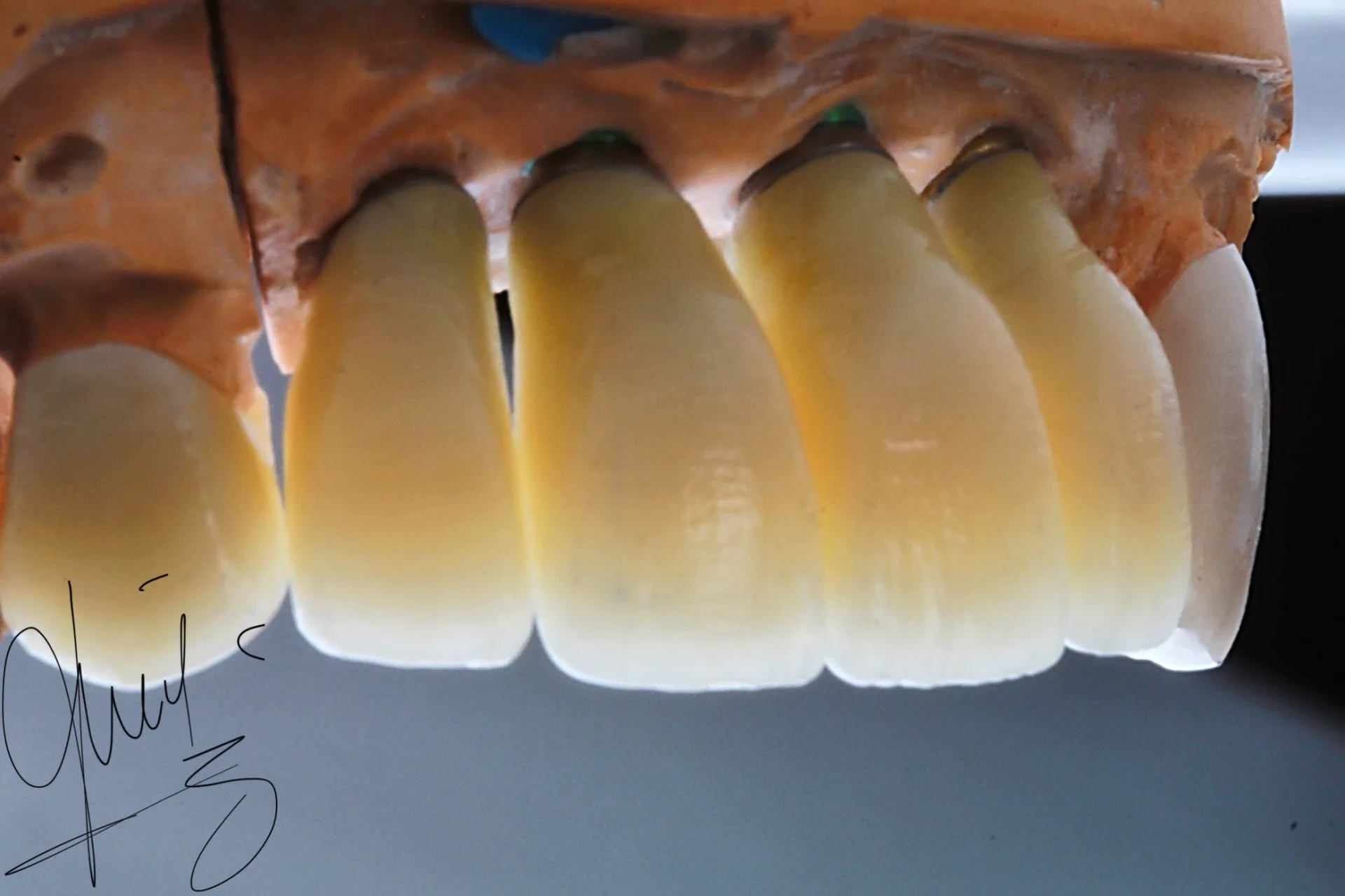 Implante dental con resultado estético — Medellín