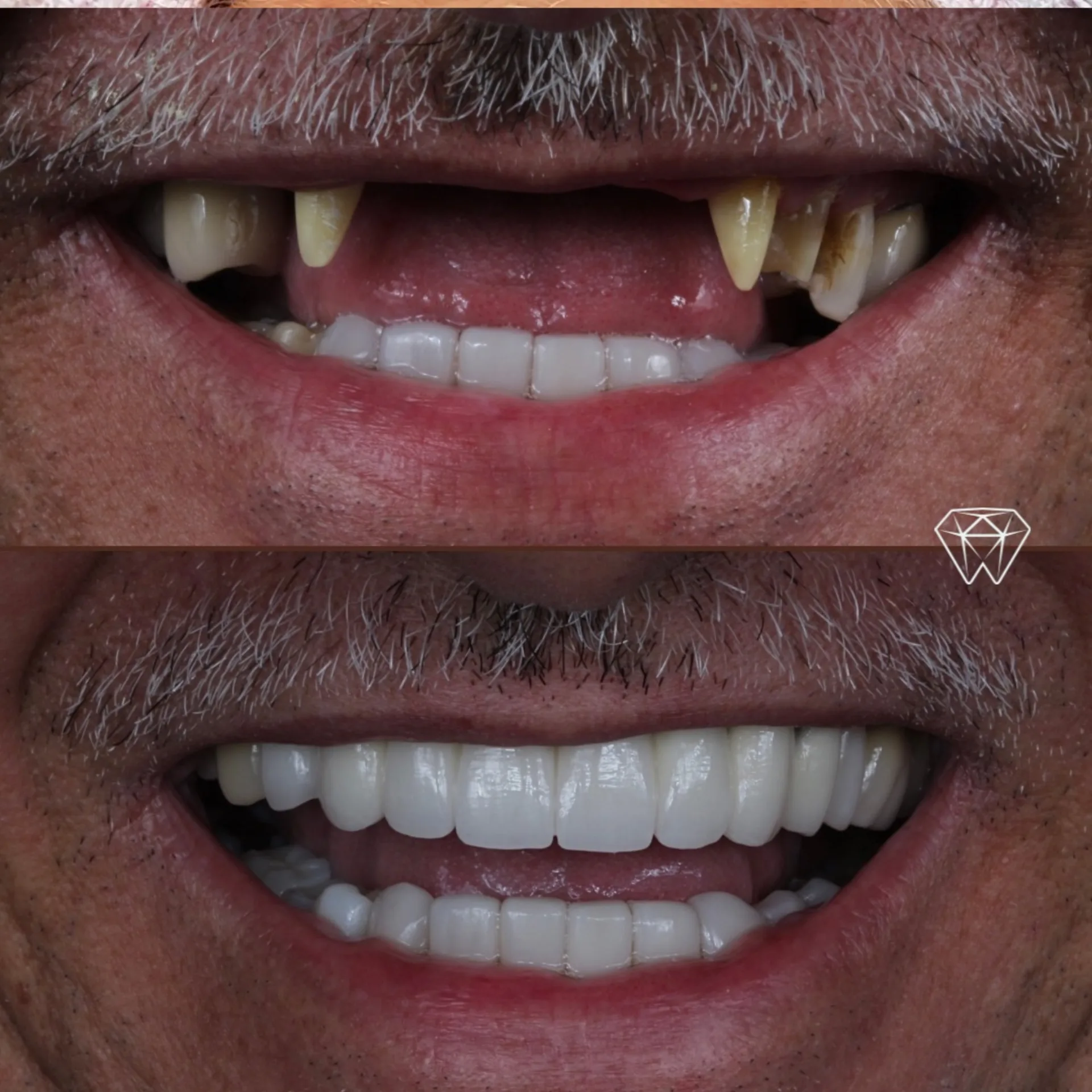 Antes y después de implante dental — Medellín