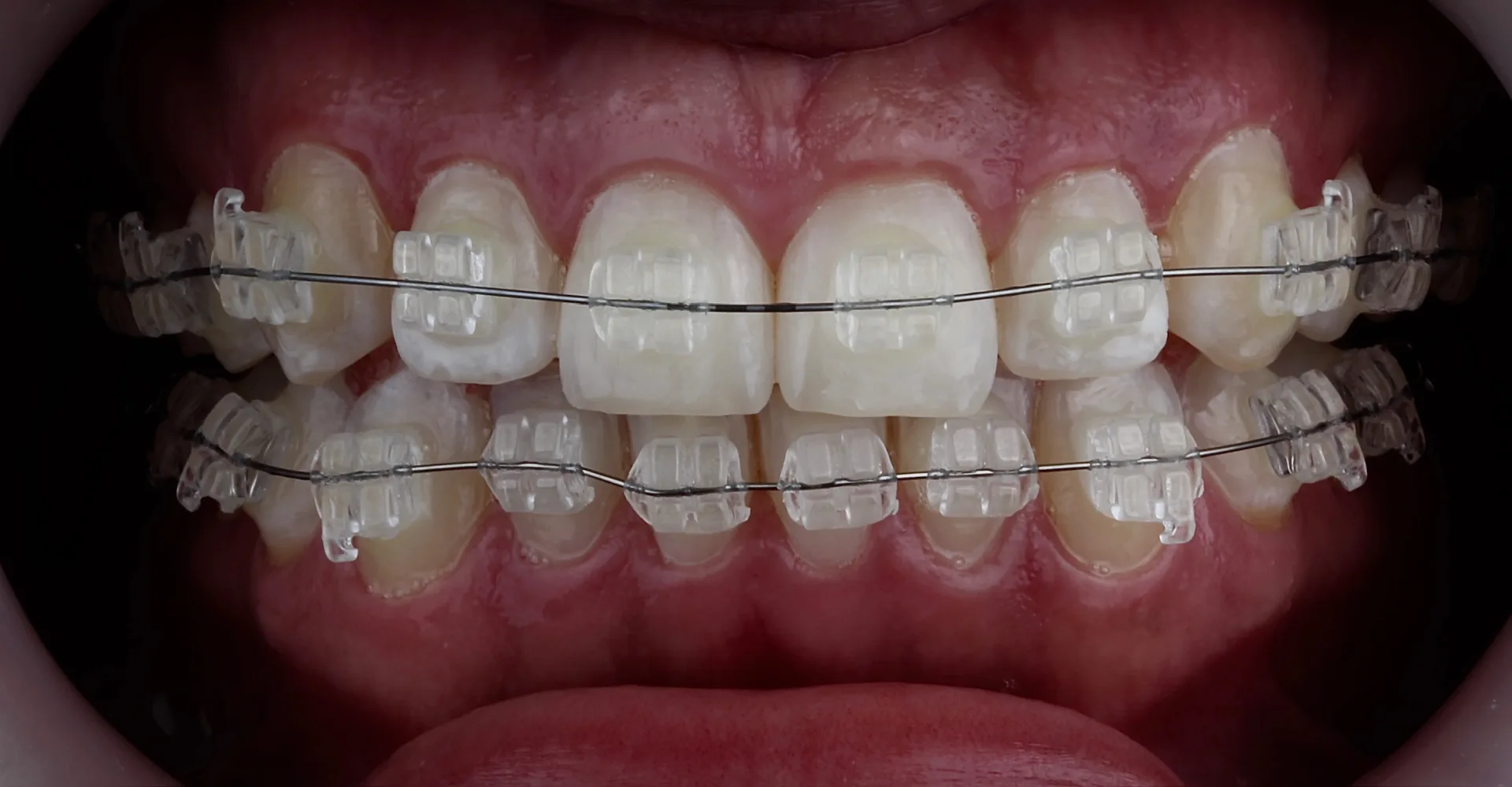 Caso clínico de ortodoncia invisible con alineadores transparentes — Medellín