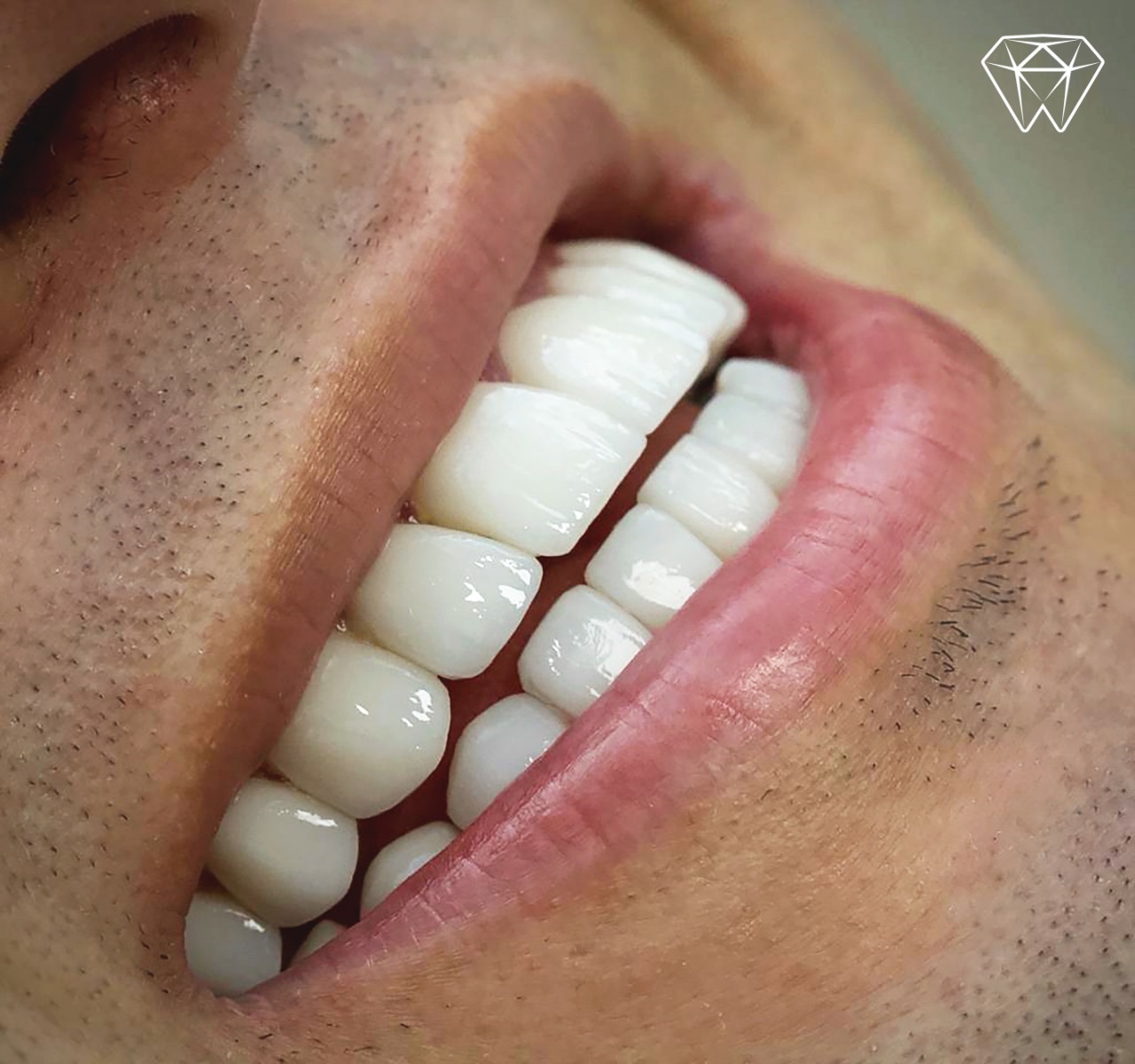 Caso clínico de diseño de sonrisa con carillas de porcelana — Medellín